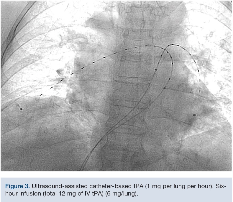 Very Low Dose and Shorter Duration CatheterDirected Thrombolytic